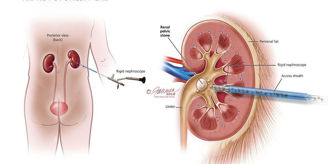 Kidney cheap stones operation