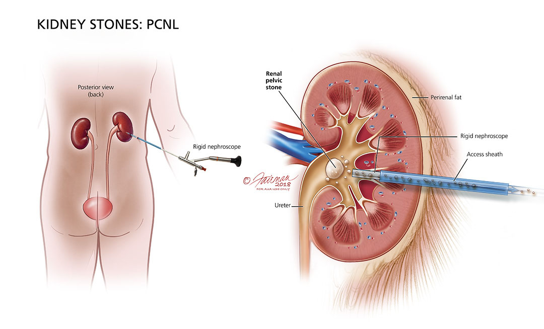 Kidney stones operation discount