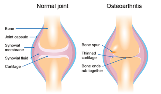 Effective Management of Hip and Knee Pain | Durdans Hospital