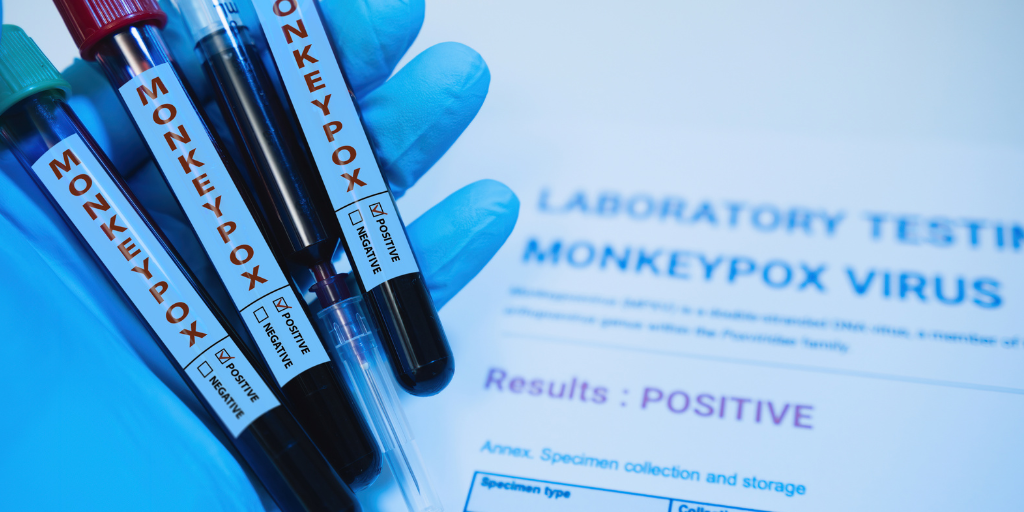 Monkey pox Is Monkeypox the Second Pandemic of the 21st Century?